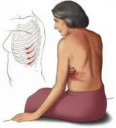 Новое медикаментозное лечение уменьшает хроническую боль после опоясывающего лишая
